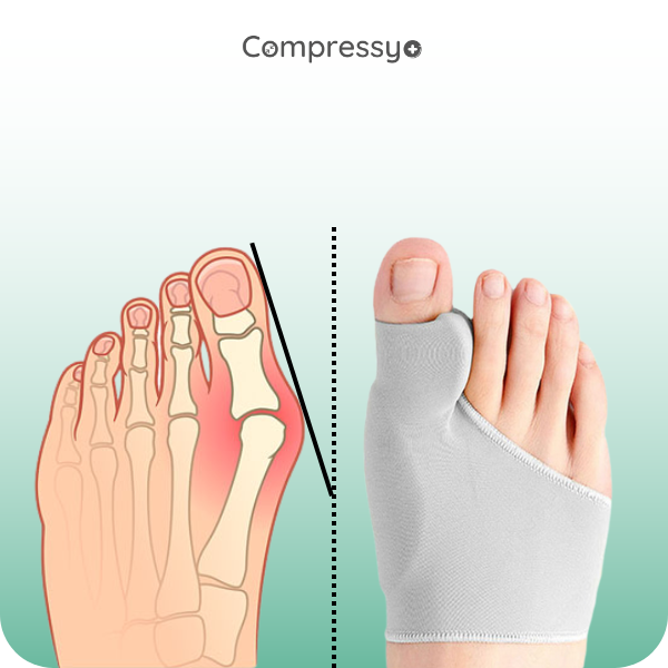 Compressy™ - Hallux Correct Set